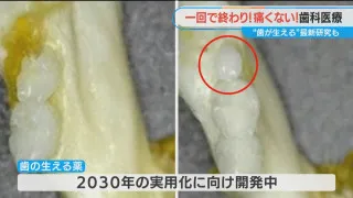 歯の詰め物治療がたった1回で完了！ 「歯が生える薬」の実用化も間近　進化する歯科治療の最前線を調査