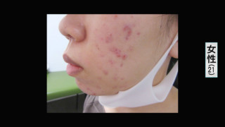 これから暑い夏！マスク、手洗いによる肌荒れの予防法と注意点は？