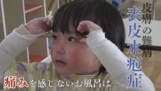 外からの刺激で水疱が‥【表皮水疱症】と闘う5歳の男の子 CBCドキュメンタリー