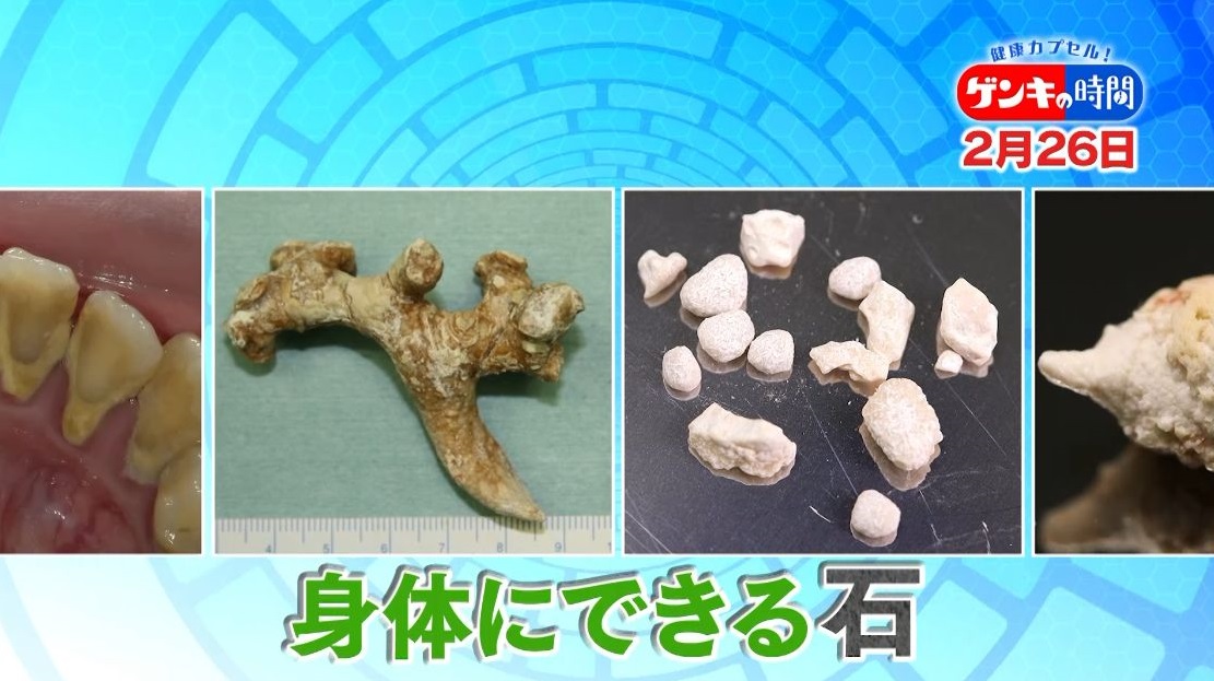 人間の身体に“恐ろしい石”…300個以上ある人も!?身体にできる危険な「石」を徹底リサーチ!石を作らないための予防法もご紹介