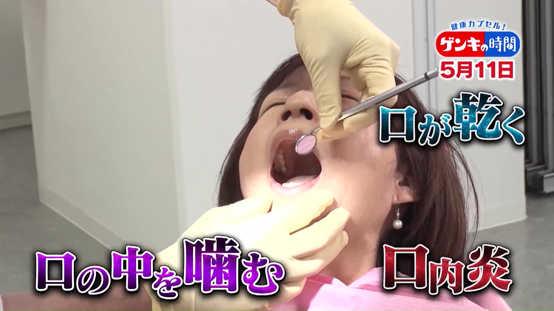 “治らない口内炎”放置で「舌がん」に!?…危険な病気の可能性も!「口トラブル」原因と対策