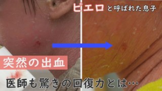 傷つきやすいけど、治りやすい…賀久くんの皮膚に医師も驚き~CBCテレビ定期配信型ドキュメンタリー「ピエロと呼ばれた息子」第56話