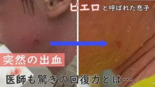 傷つきやすいけど、治りやすい…賀久くんの皮膚に医師も驚き~CBCテレビ定期配信型ドキュメンタリー「ピエロと呼ばれた息子」第56話