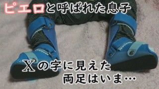 「くるぶしで立っていた」皮膚のかゆみだけでなく、両足の変形とも向き合う…~CBCテレビ定期配信型ドキュメンタリー「ピエロと呼ばれた息子」第58話 #CBCドキュメンタリー
