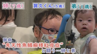 魚鱗癬と闘う仲間との交流…三重と京都の“魚鱗癬の会”「ピエロと呼ばれた息子」第67話