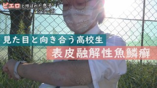 手のひら・足裏の皮膚だけ正常な“魚鱗癬”…学校生活は?表皮融解性魚鱗癬~定期配信型ドキュメンタリー「ピエロと呼ばれた息子」第73話