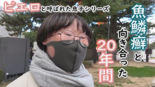 20歳の魚鱗癬と闘う女性‥成人式を迎えた今、思うこと~定期配信型ドキュメンタリー「ピエロと呼ばれた息子」第86話