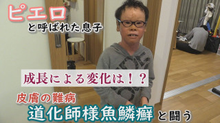 もうすぐ3年生!大きくなって剥がれる皮膚の量も…~配信型ドキュメンタリー「ピエロと呼ばれた息子」第134話